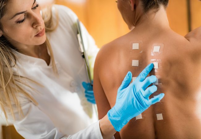 Alergia al sol, ¿Cómo saber si tengo?