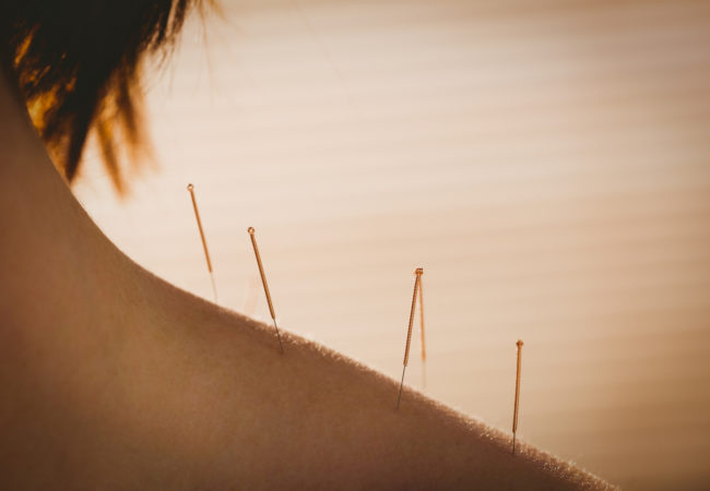 Acupuntura ¿qué es y para qué sirve?